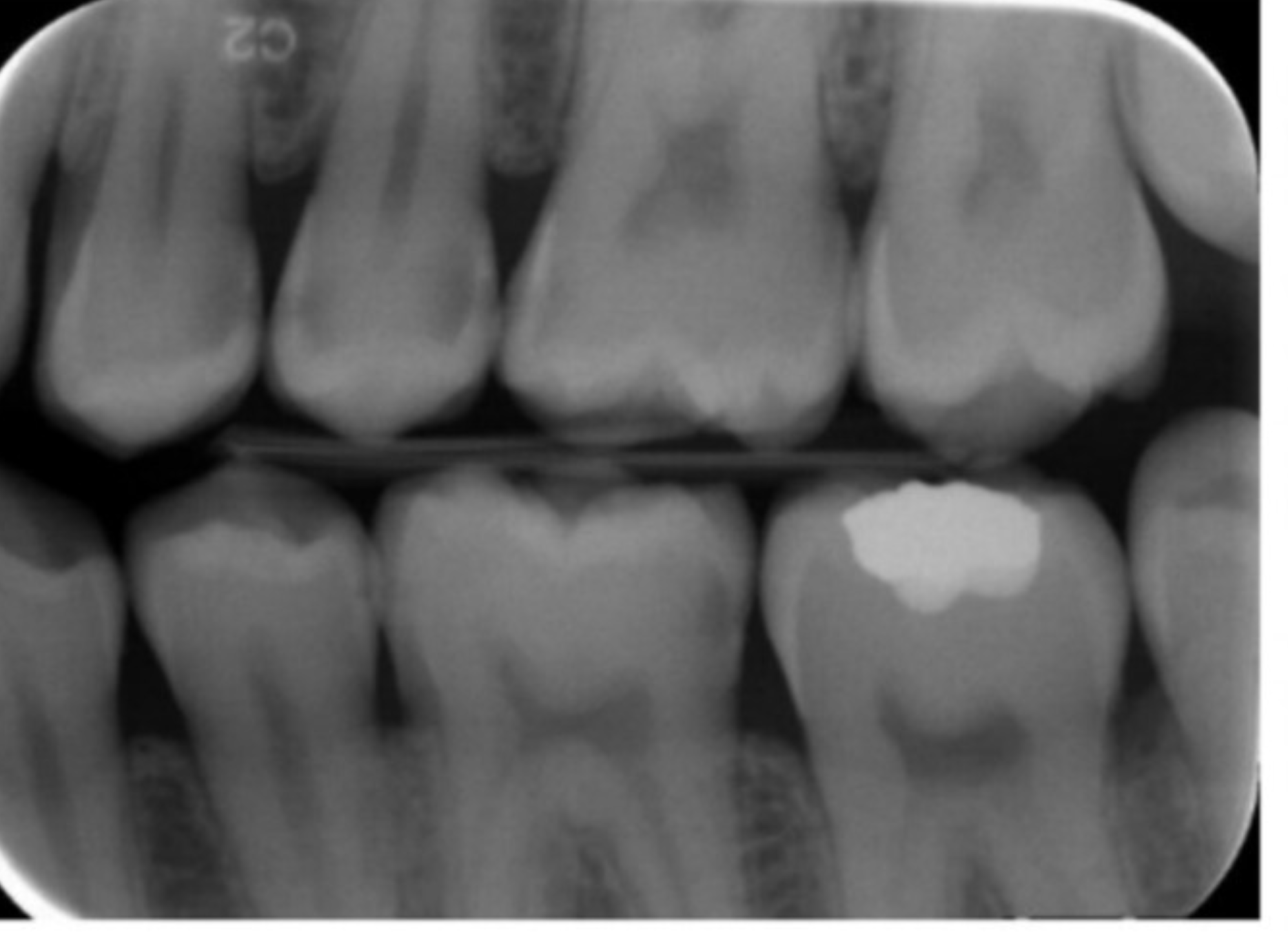 Bitewing radiograph of posterior teeth