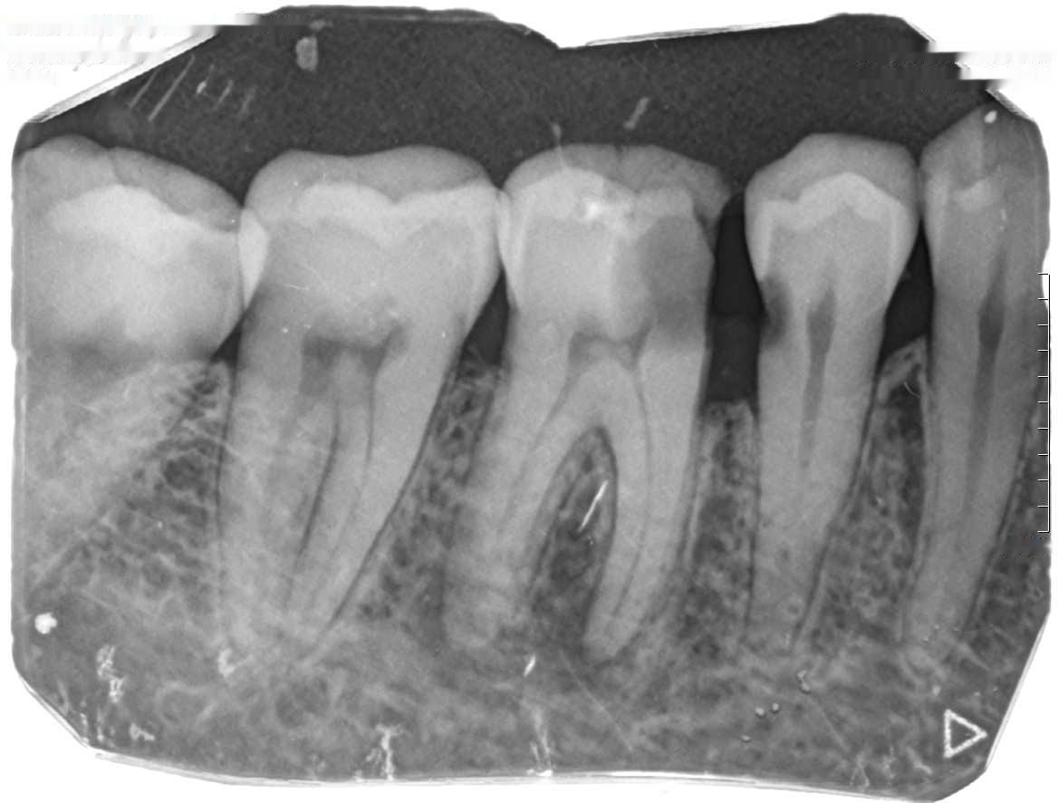 Periapical radiograph of mandibular molars